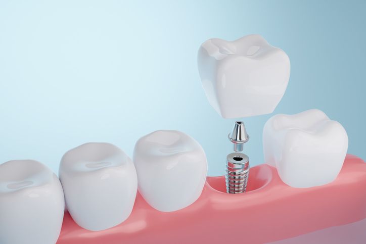 Restorative design at Springs Dental